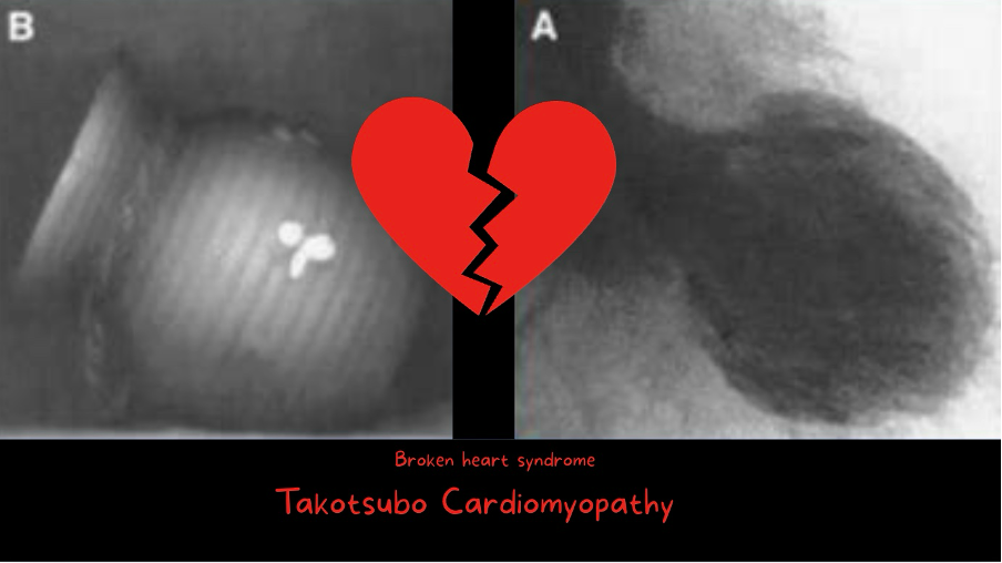 takotsubo