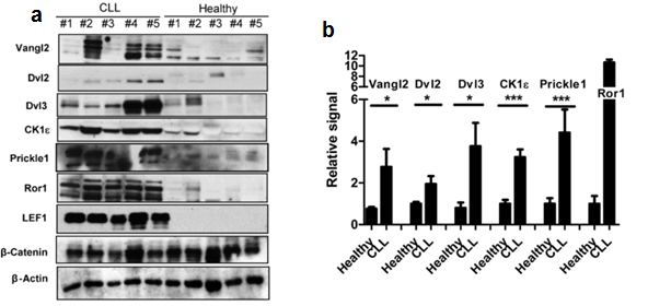 Figure 3: PCP genes and proteins are upregulated in CLL cells. (a) The amounts of the indicated PCP proteins analysed by Western blotting in B cells of patients with CLL and healthy controls. Patients with CLL have greater expression of PCP pathway proteins. (b) Quantification of data in (a).