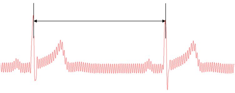 Figure 1: R-R interval in ECG signal