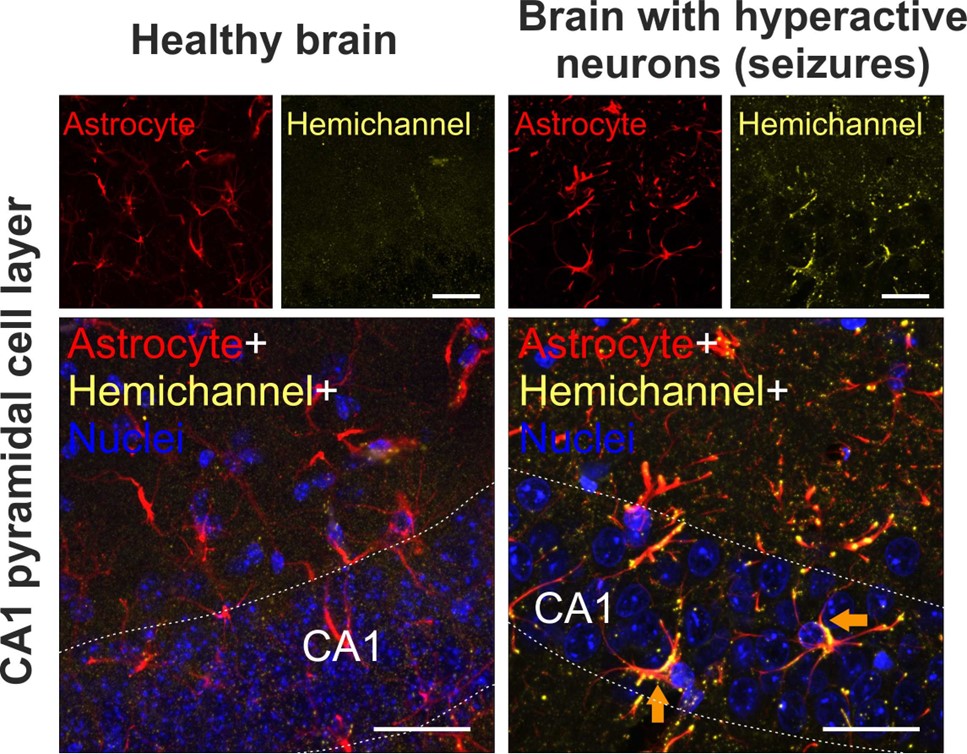 Hemichannel expression in CA1 astrocytes in healthy and brain with hyperactive neurons