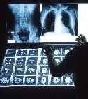 x-ray viewed against a lightbox