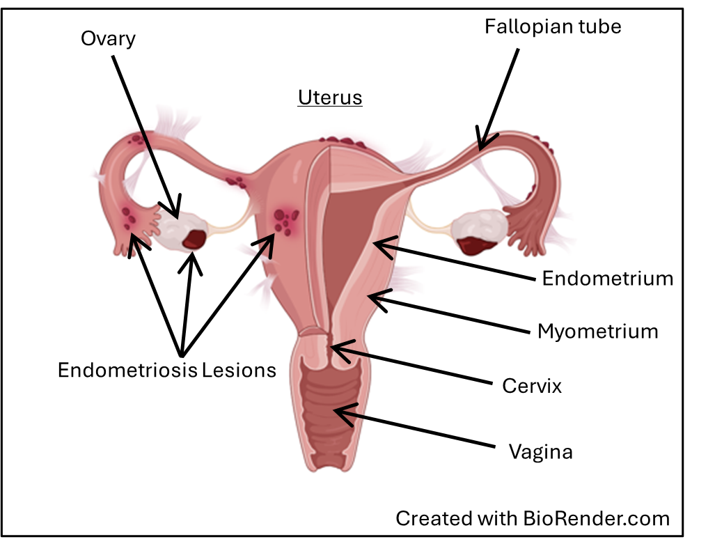 Uterus with endometriosis lesions