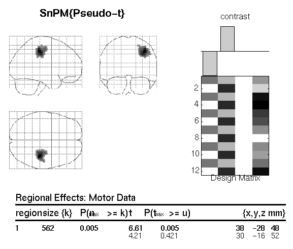 SnPM ST Output Top