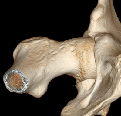 CT scan of right hip that shows the egg shaped ball