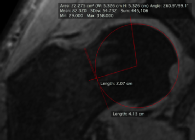 MRI scan indicating difference in angle of hip joint