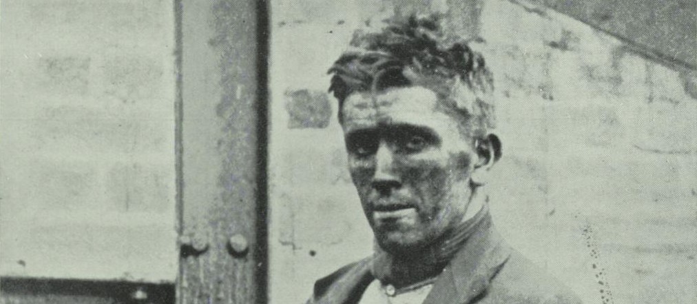 Part of a photograph of a miner, above ground after being involved with an accident. He is looking directly at the camera and has coal dust on his face.